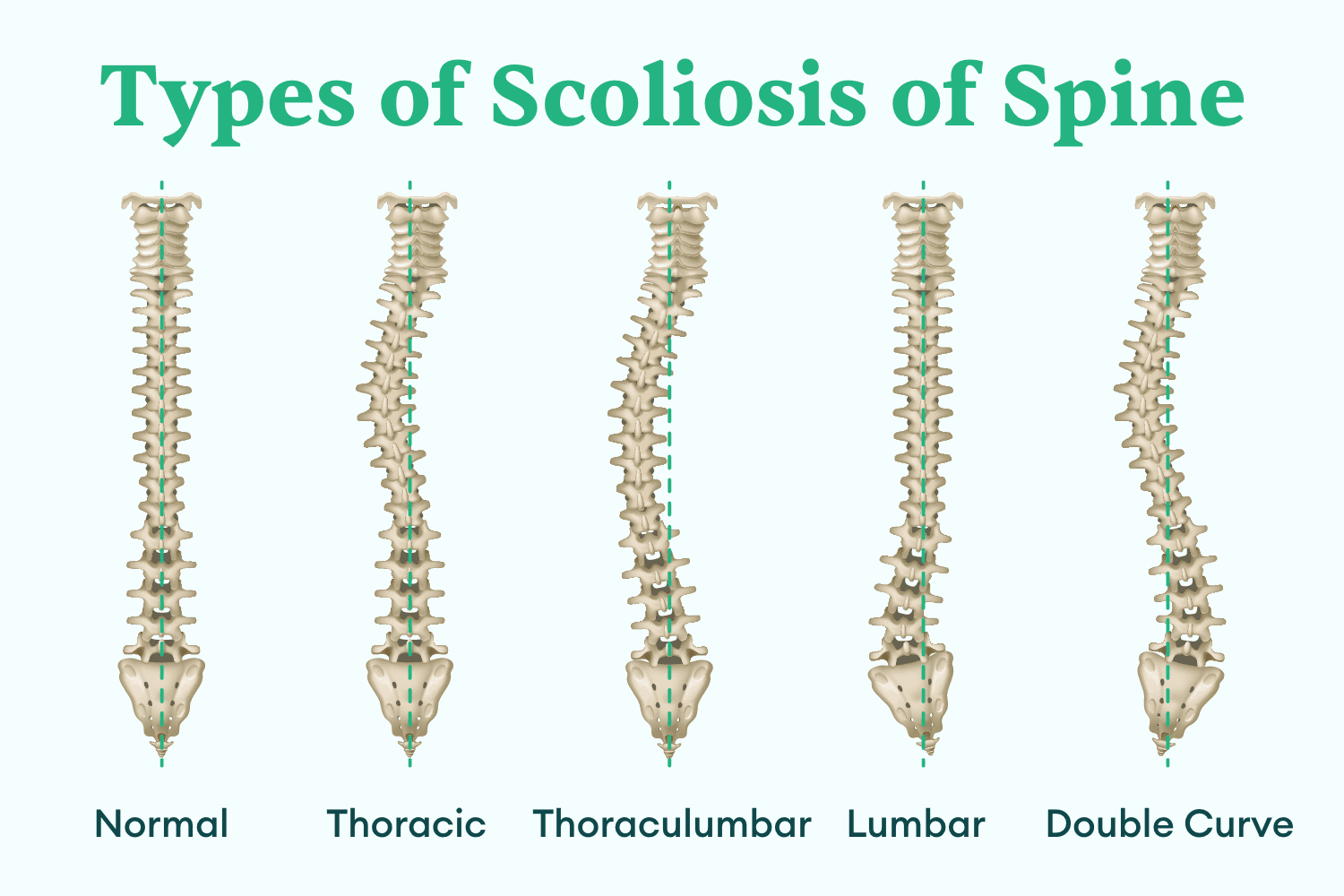 Illustration showing the different types of scoliosis of spine