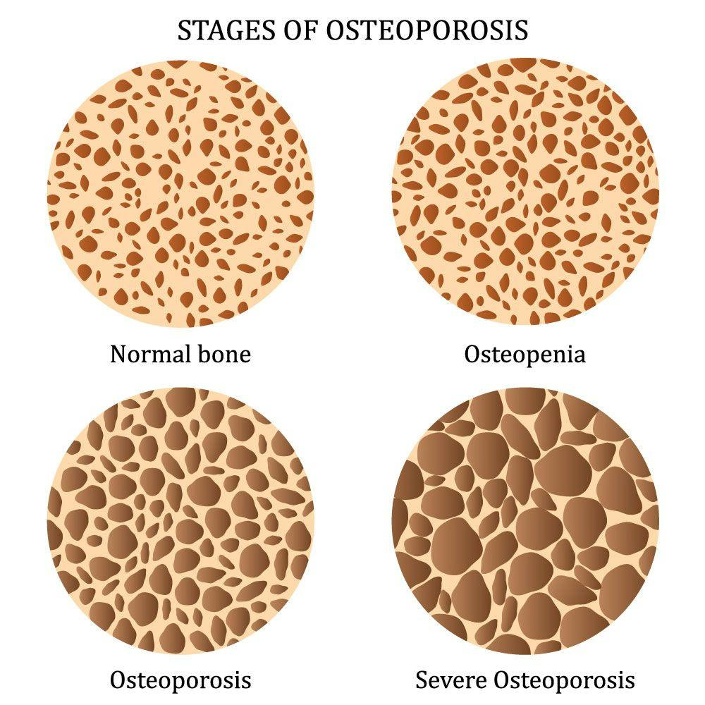 Diagram of the stages of osteoporosis