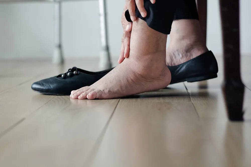 A woman's swollen feet