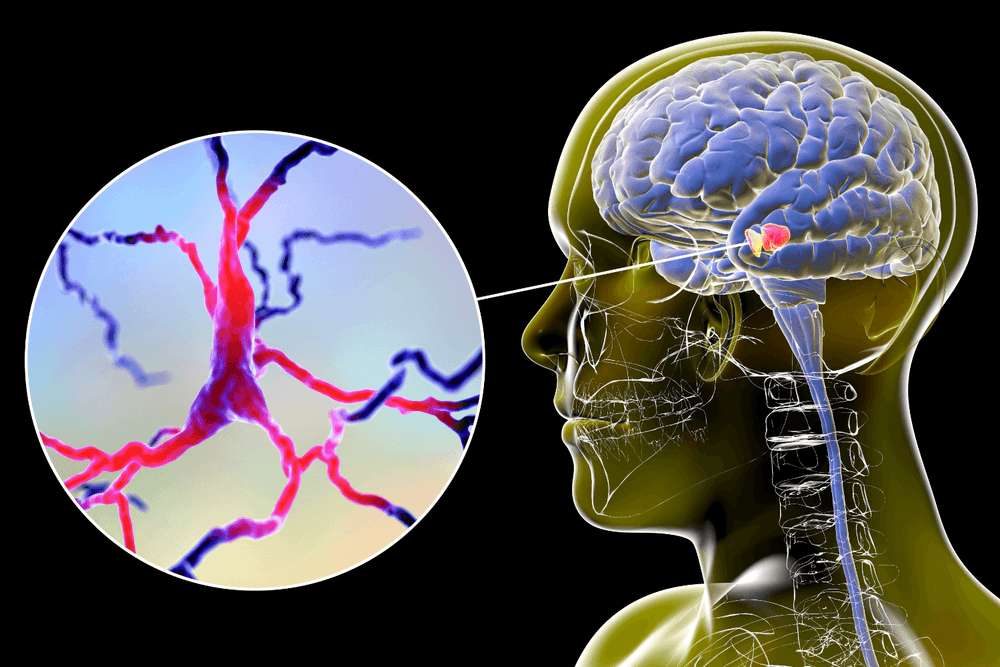X-ray for huntingtons disease