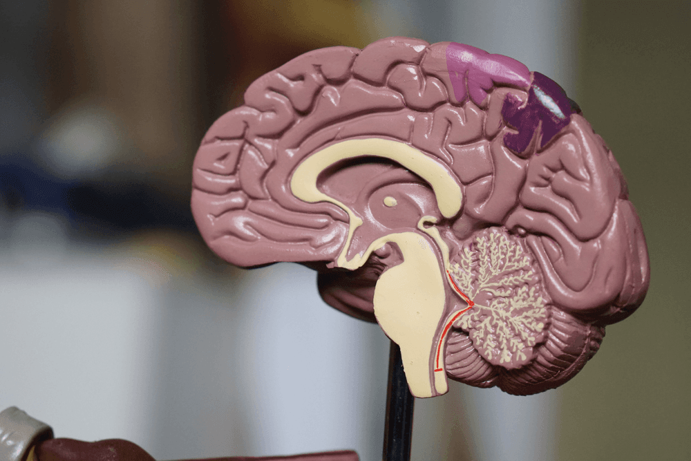 Image of brain with Alzheimers