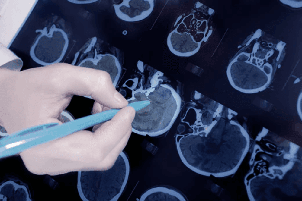 Symptoms of dementia