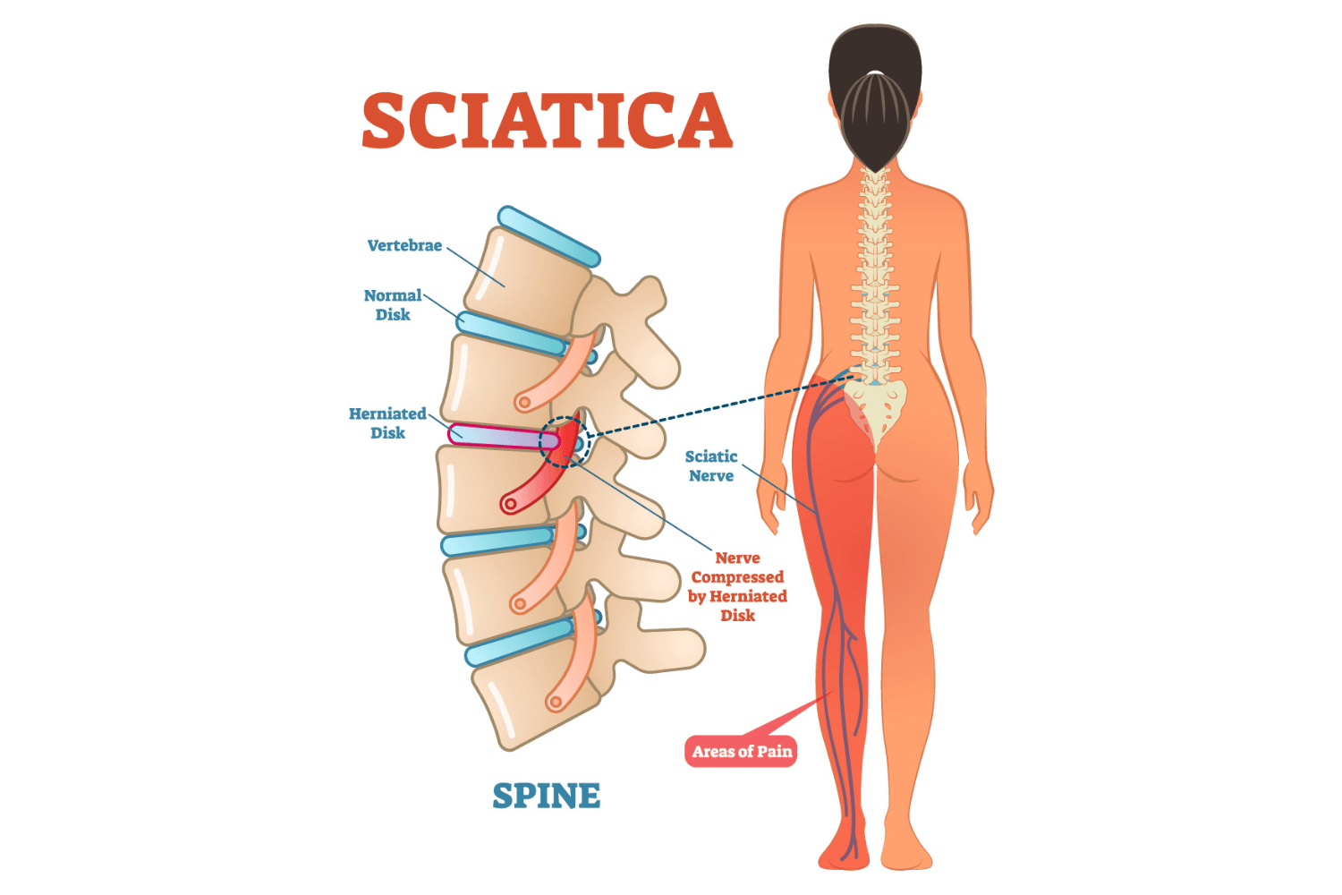 Information about Sciatica